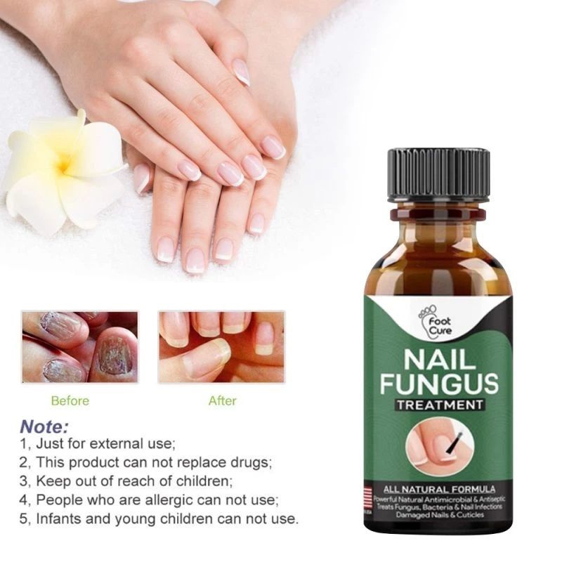 Nail Fungus Treatment / 30ml/ Best Nail Repair/ Eelhoe/ Kuku Rosak ...