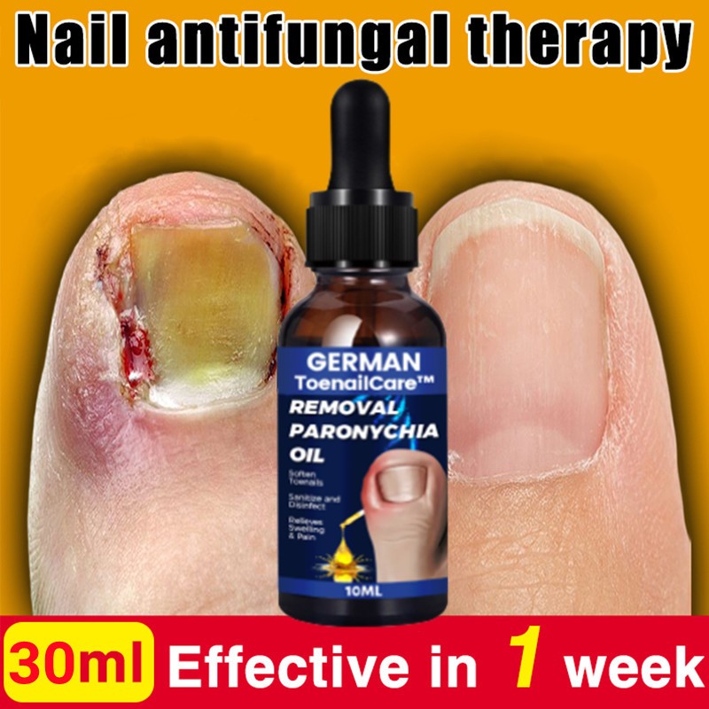 Ingrown Toenail Removal Paronychia Toenailcare Toenail Correction Nail