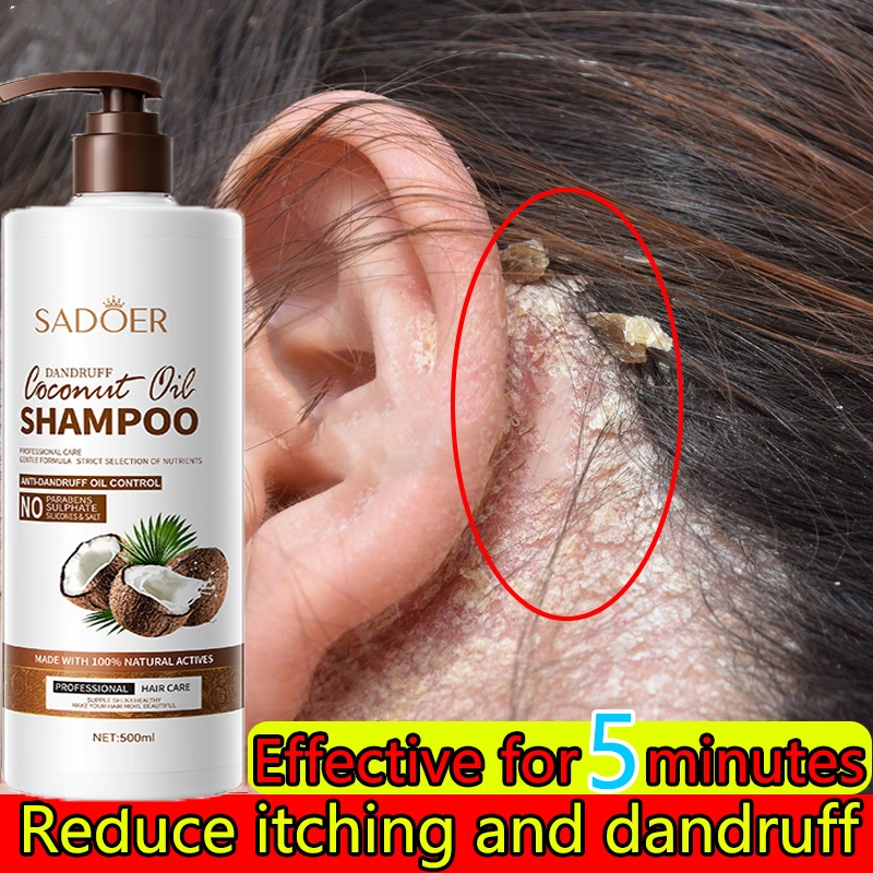 syampoo kelemumur dan gatal kepala psoriasis scalp itchy scalp