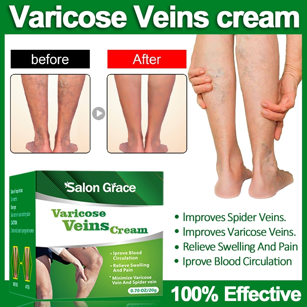 South Moon Varicose Veins Cream for Legs Eliminate Varicose Veins and