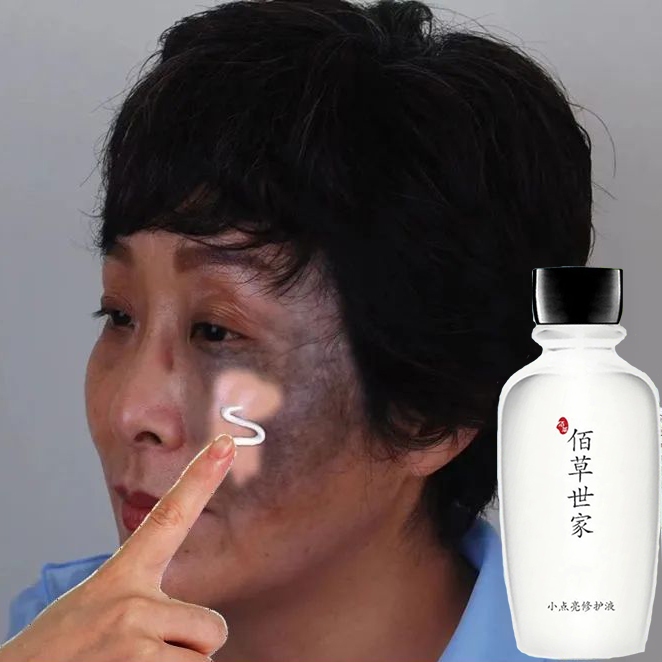Birthmark Breakthrough Learn About How To Get Rid Of Birthmarks Naturally 3 - p7xmc97