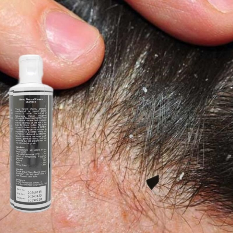 Syampoo Kelemumur dan Gatal Kepala Herbal shampoo kelemumur dan rambut ...