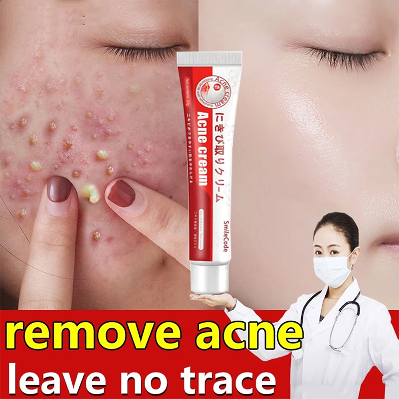 acne treatment pimple cream praventac acne pair cream ubat jerawat 祛痘膏 ...