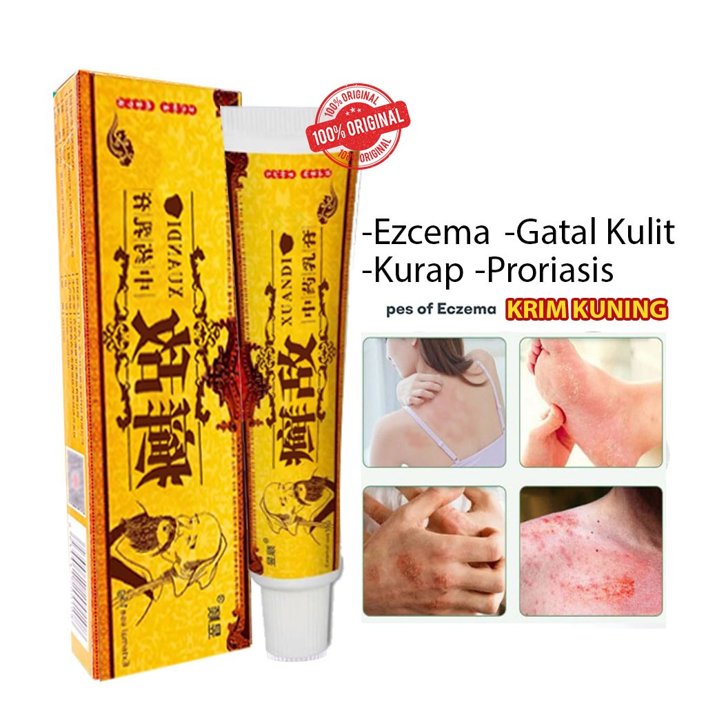 Ekzema Psoriasis Kurap Gatal Kulit Ubat Krim Herba Cina 15g / Eczema ...