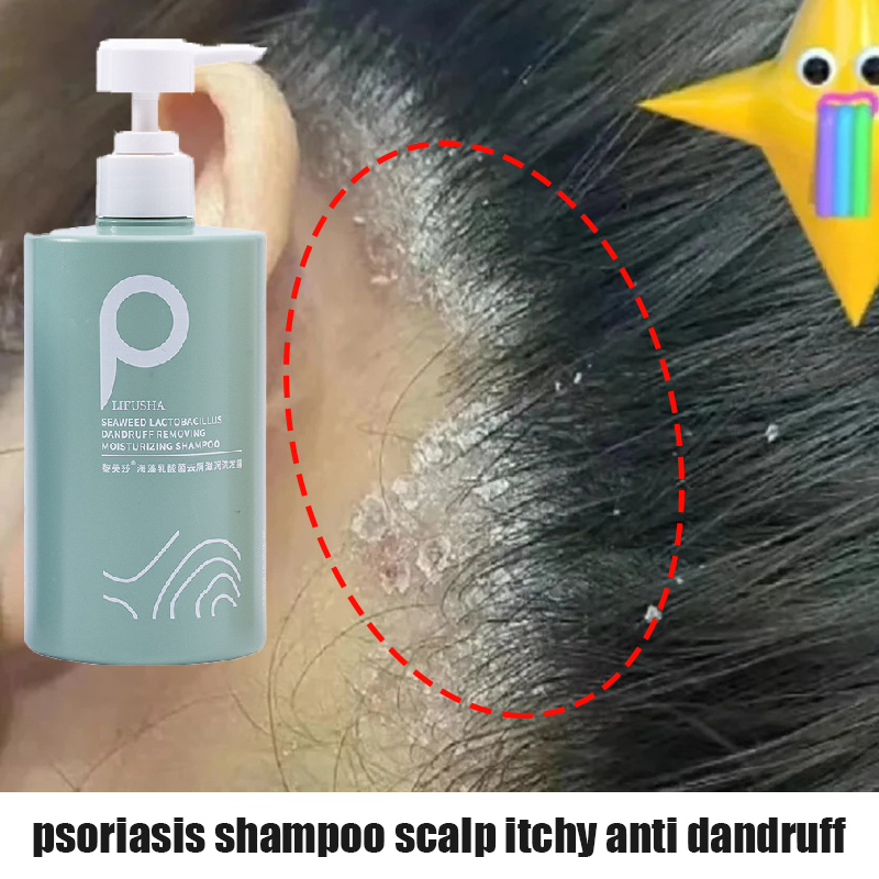 Syampoo kelemumur Psoriasis shampoo Itchy scalp Ubat kelemumur kepala ...