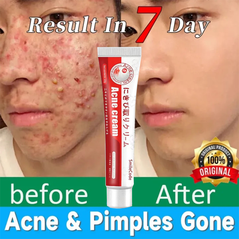 acne treatment pimple cream praventac acne pair cream ubat jerawat 祛痘膏 ...