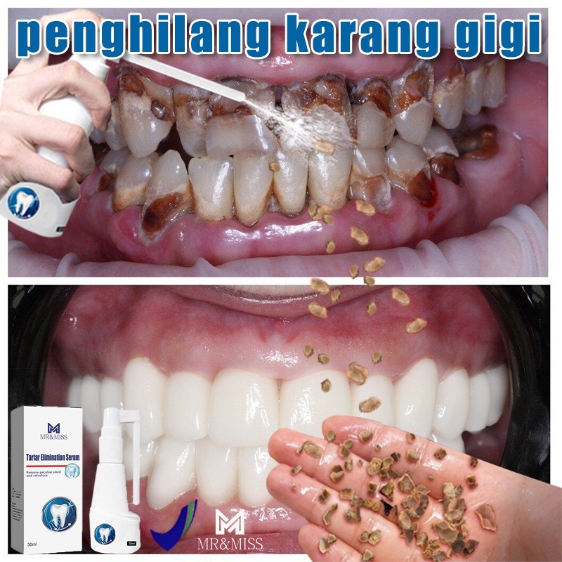 Tartar Cleaner Spray Tartar Remover Karang gigi remover plaque gigi