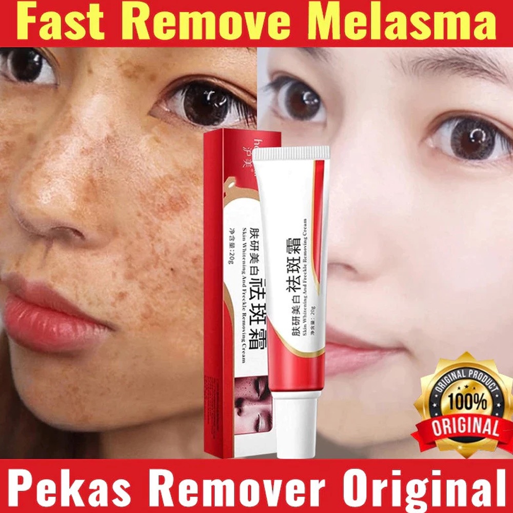 Whitening Freckle Cream Remove Melasma Cream Remove Dark Spots Melanin ...