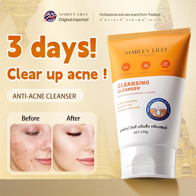 Acne Face Wash Blackhead Removal Moisturizer Pimple Salicylic Acid ...
