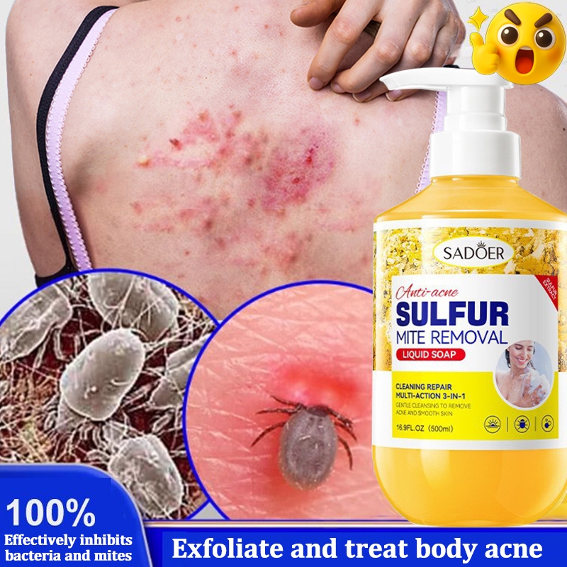 Acne Removal Body Wash 500l Sulfur Antibacterial Body Wash Oil control ...