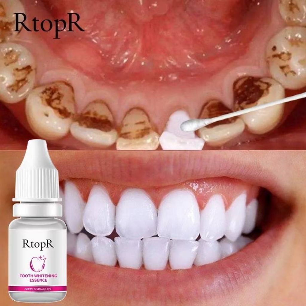 cecair pemutih gigi hilangkan hitam kuning gigi RTOPR TOOTH WHITENING ...