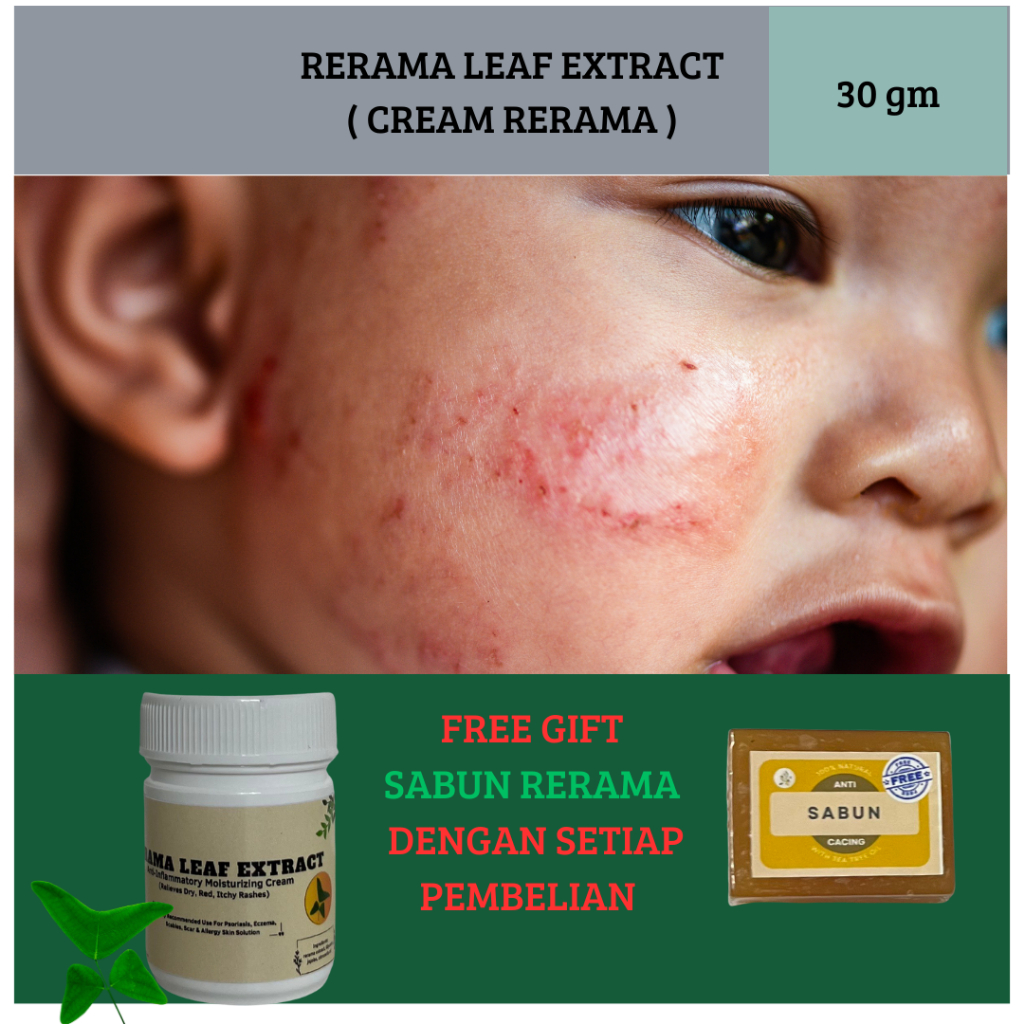 KRIM GATAL DAUN RERAMA - KULIT GATAL [30 GRAM]+ FREE GIFT+FREE SHIPPING ...