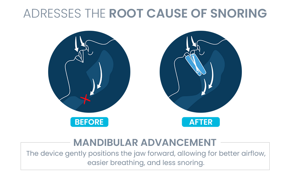 Quies SomnoFit Anti Snore Mouth Guard | Adjustable MAD Sleep Aid ...