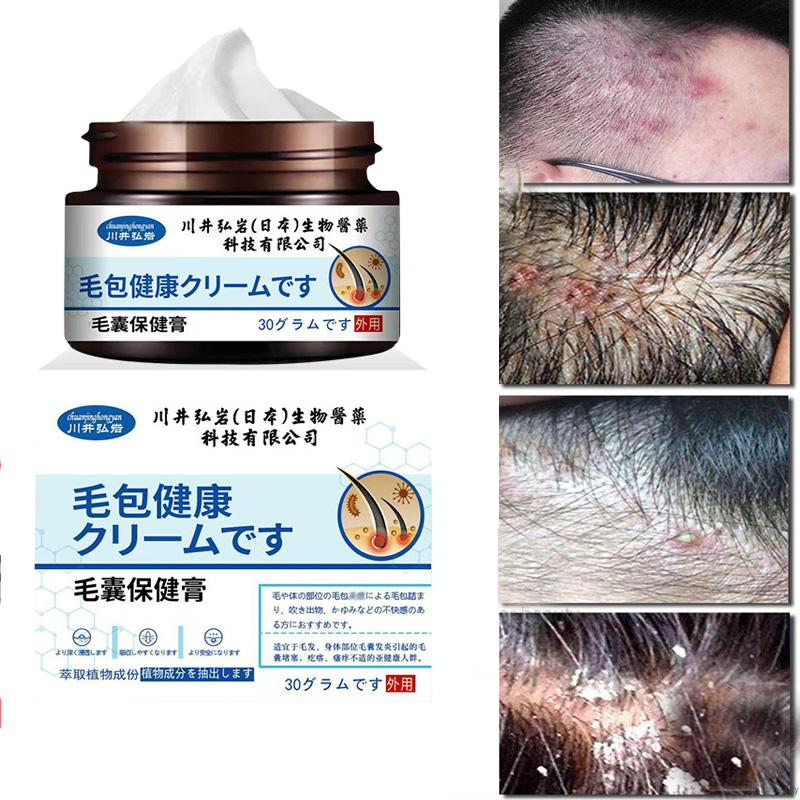 Seborrheic dermatitis cream scalp treatment psoriasis folliculitis ...