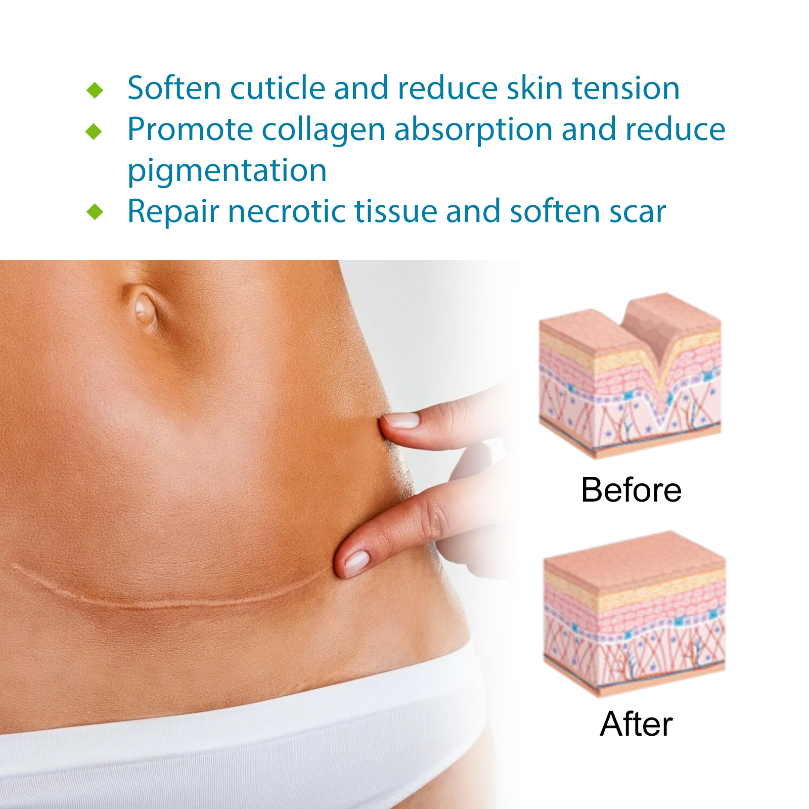West&Month Medical Silicone Scar Patch Silicone Scar Sheets Repairs ...