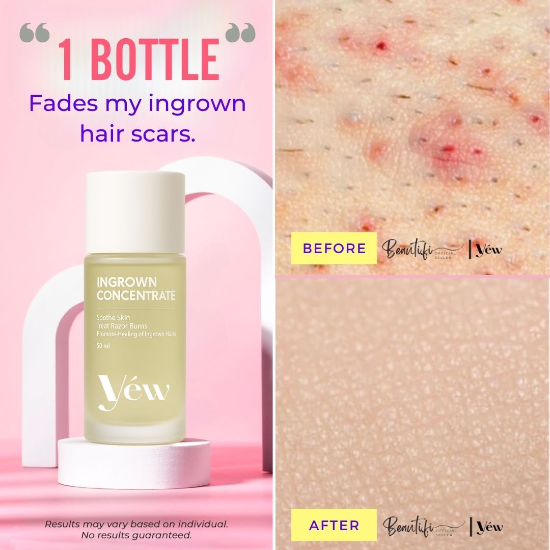 Ingrown Hair Oil Serum | Fast Relief for Razor Bumps & Ingrown Hairs ...