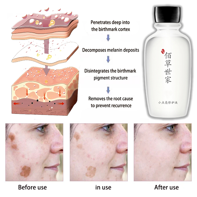 natural birthmark remover black red brown birthmarks solution melanin ...