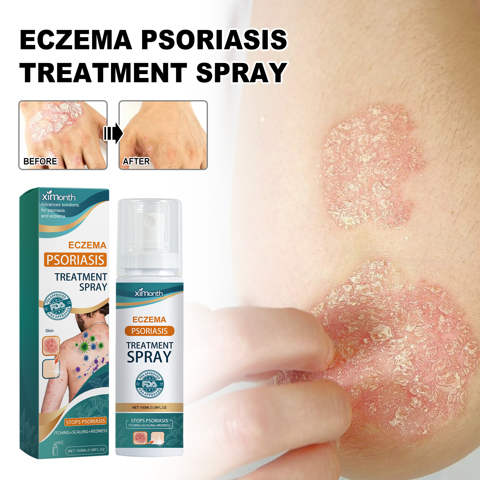 Eczema Psoriasis Treatment Spray 100ml Skin Tinea Repair Spray Soothe ...