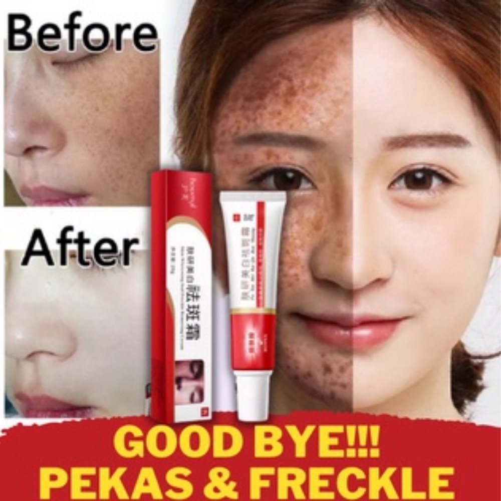3PCs effective melasma cream pigmentation remover cream and dark spot