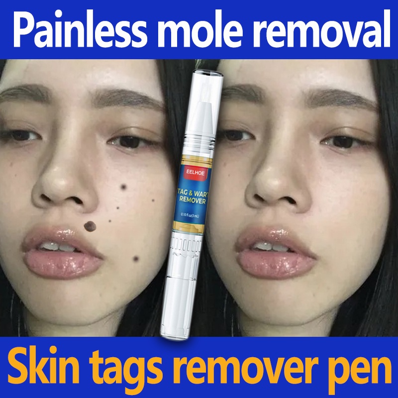 1 pcs/box Effective Removal Will Pen Pain-free Remover Quickly Warts ...