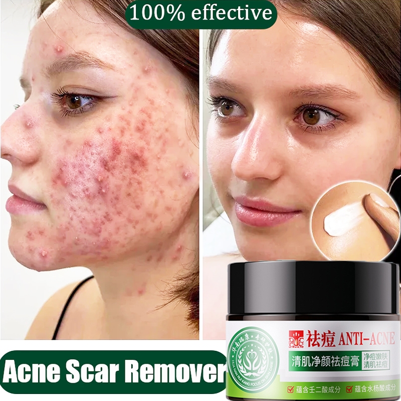 View of Acne treatment ointment Treatment of adolescent acne Facial scar acne ...
