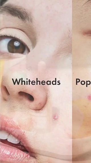 Pimple Patch - Acne Treatment Removal - Breathable, Invisible ...