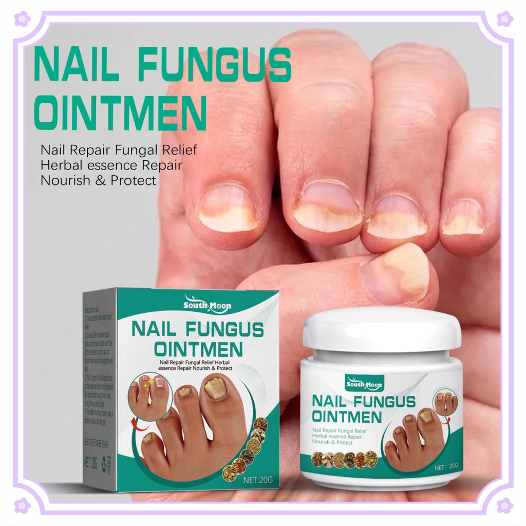 South Moon 20g Toe Nail Fungus Treatment Cream Onychomycosis Paronychia