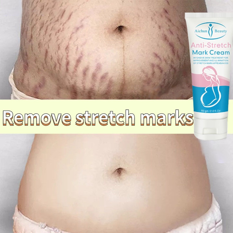 Stretch Mark Cream Scar Removal Cream Remove Stretch Marks Scar Removal cream Cesarean Section