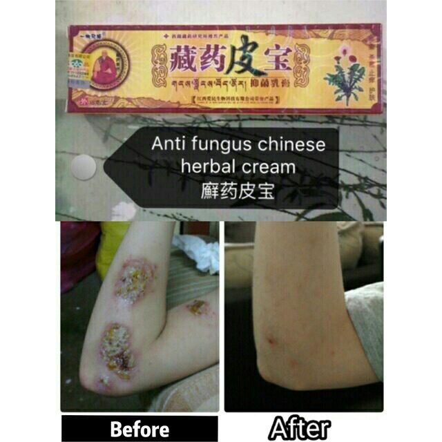 Natural Chinese Herbal Medicine Eczema Treatment Anti Bacterial Skin