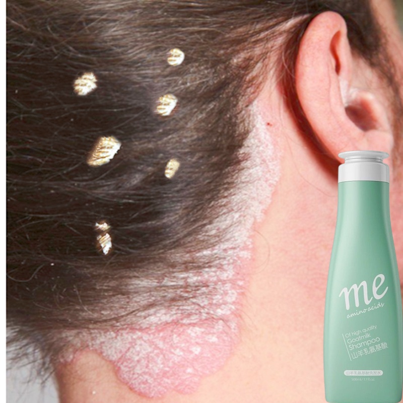 Shampoo kelemumur dandruff shampoo anti dandruff anti mites shampoo