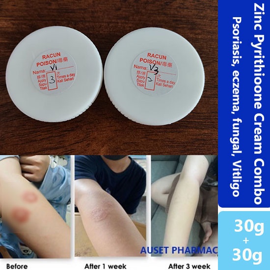 FUNGAL/ECZEMA/PSORIASIS SKINCARE CREAM V1& V3 FROM CLINICKRIM KINIK