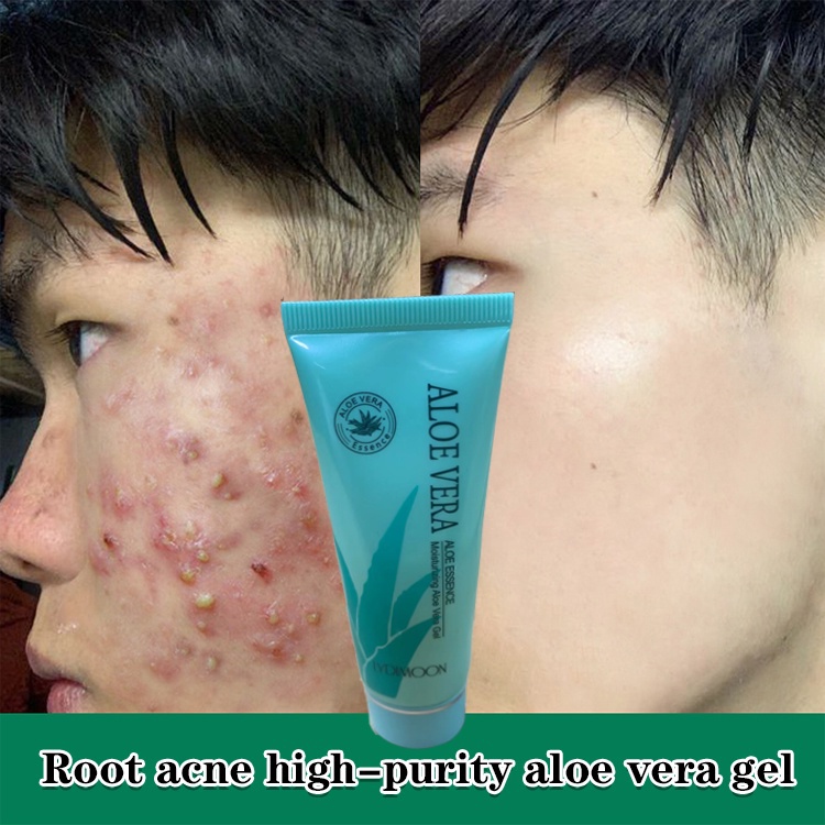Aloe vera gel sunburn repair whitening cream face 40g to remove acne