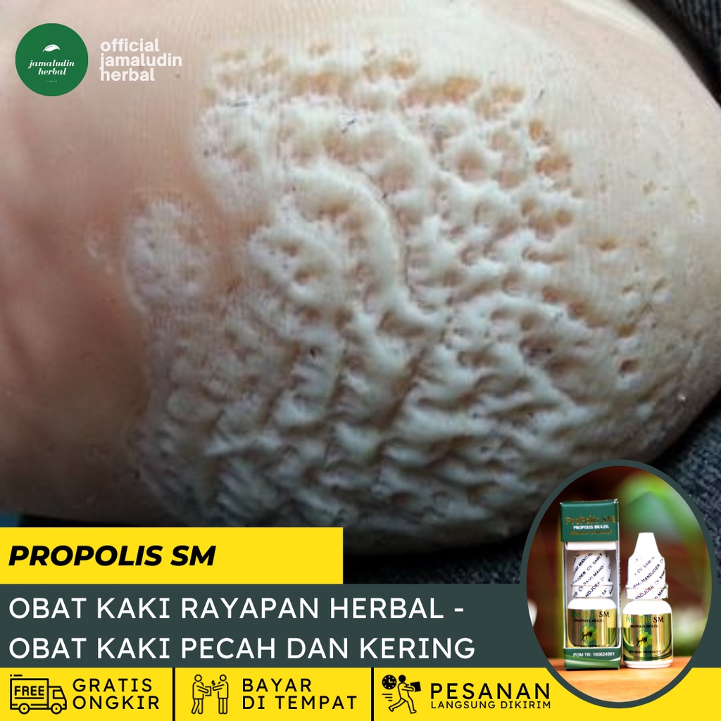 Bacterial Infection Perforated Foot Drops, Dry Odor Termite Foot