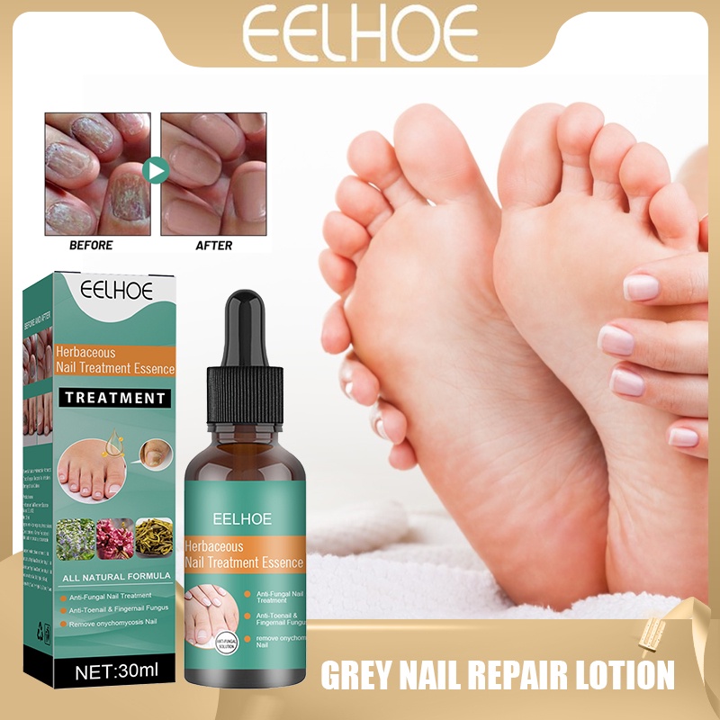 Eelhoe Nail Fungus Treatment Original Natural Onychomycosis Remover ...