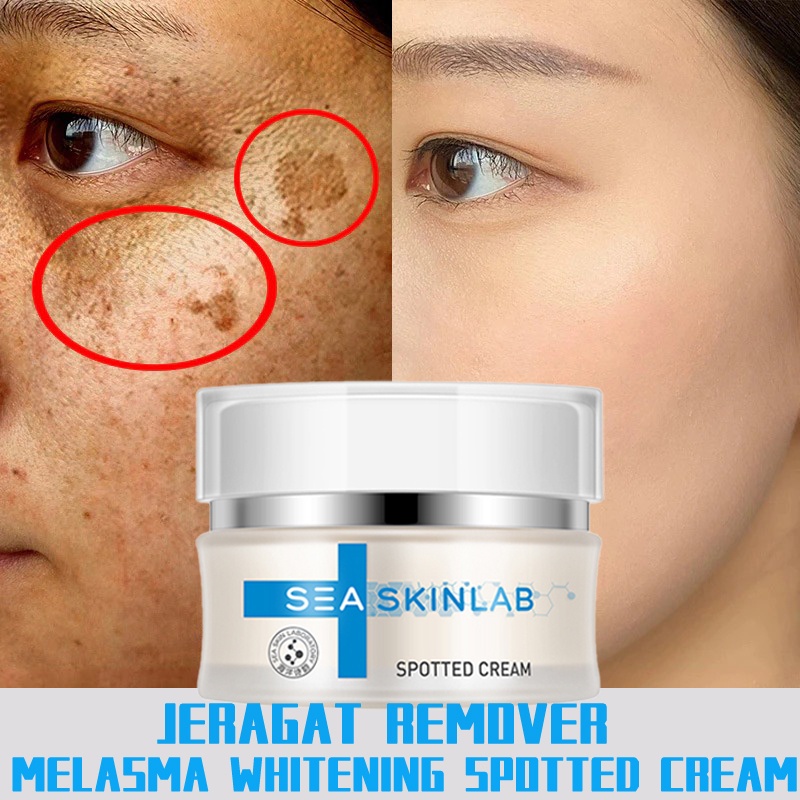 Whitening pigmentation remover cream/krim jeragat 30g 祛斑霜 melasma