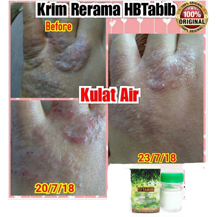 Krim Rerama gatal herba Original HQ ekzema eczema kurap | Shopee Malaysia