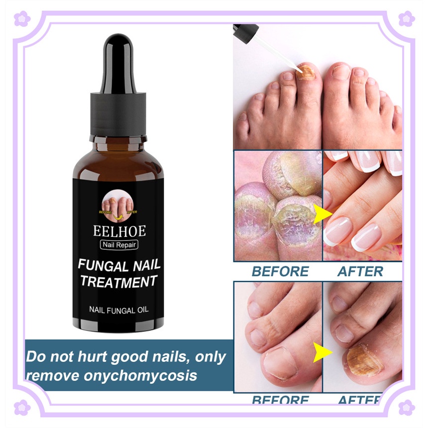 EELHOE 30/50ml Nail Fungal Treatment Feet Care Essence Nail Foot