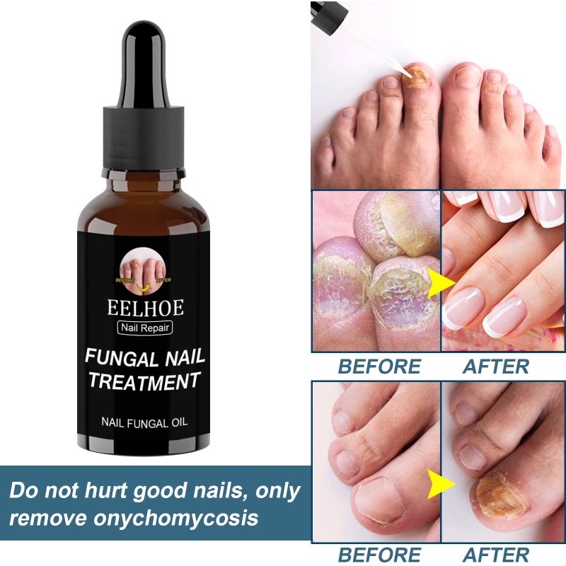 Ubat Kuku Rosak Eelhoe Nail Serum Fungal Nail Treatment Fungas Repair