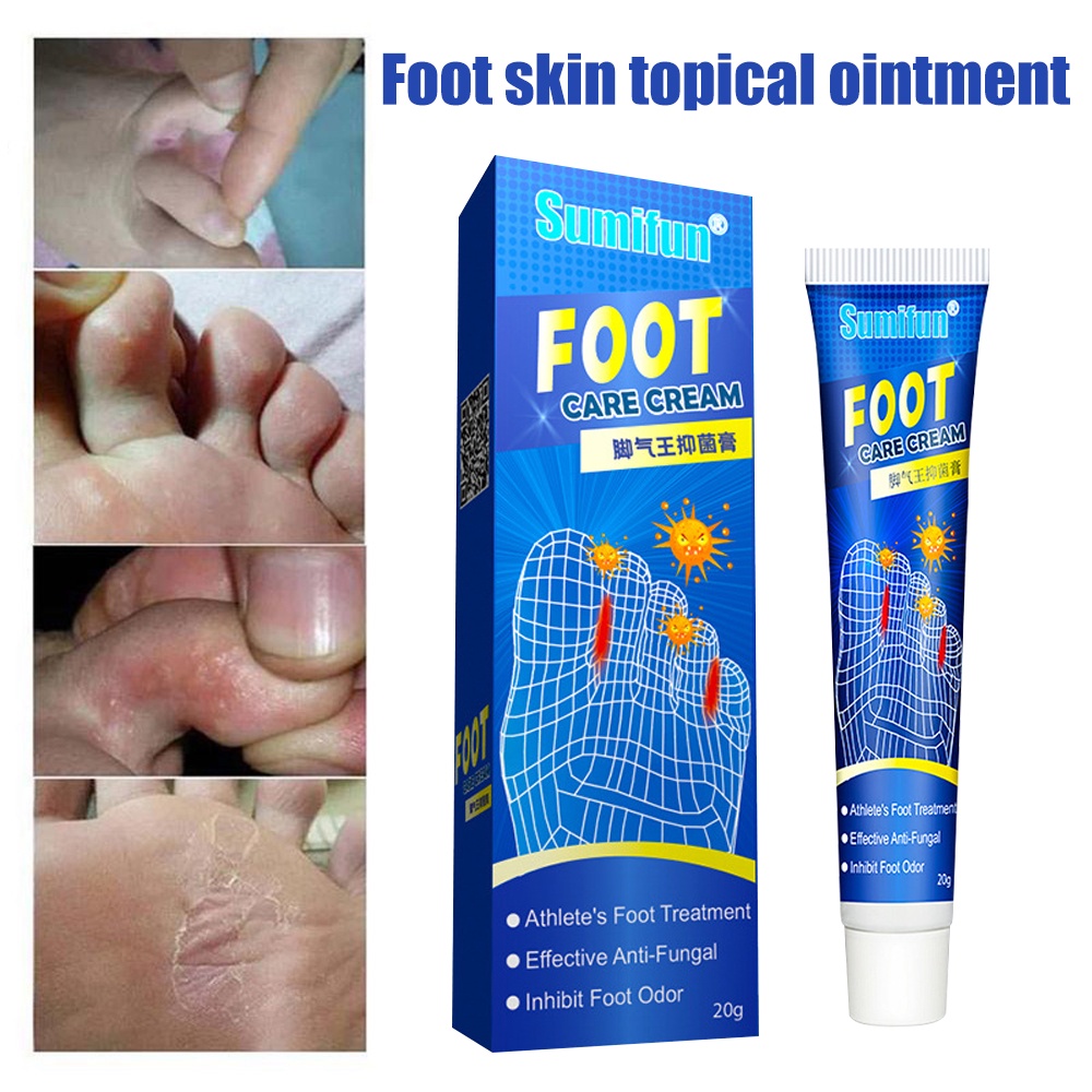 Kaki mengelupas Kulat air Kaki gatal berbau Foot fungus Sumifun ...