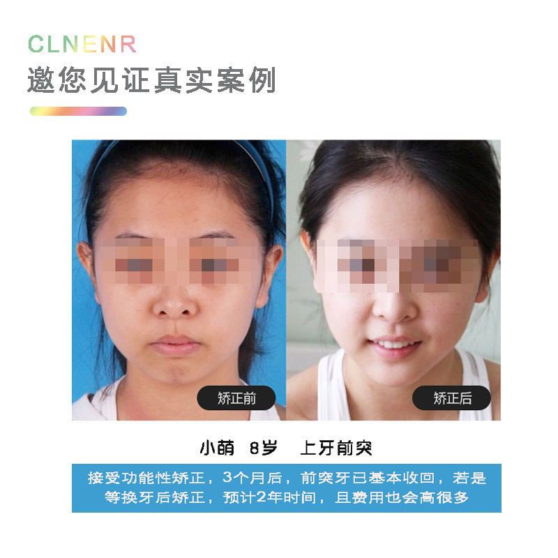 6d Children's Dental Braces Braces Corrector Teeth Mouth Protruding ...