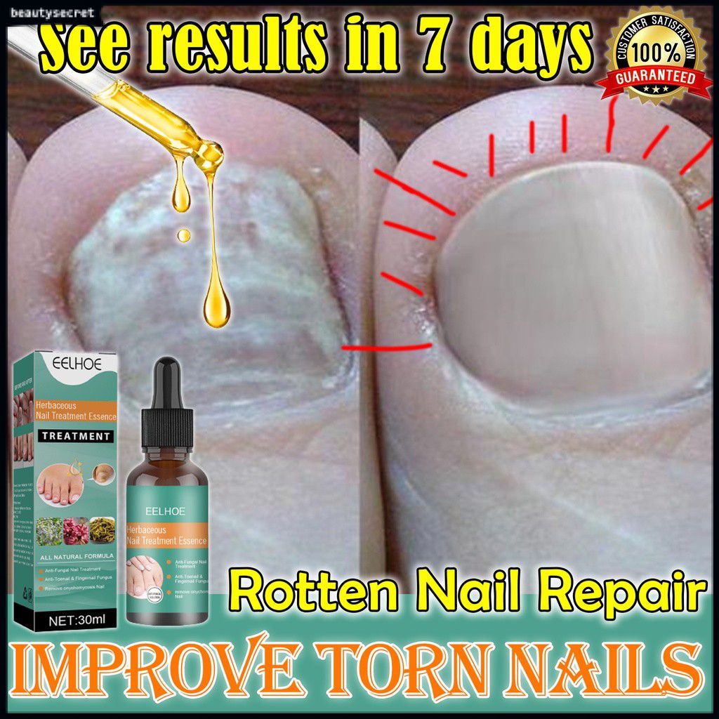 EELHOE Herbaceous Nails Repairing Serum Onychomycosis Paronychia Anti
