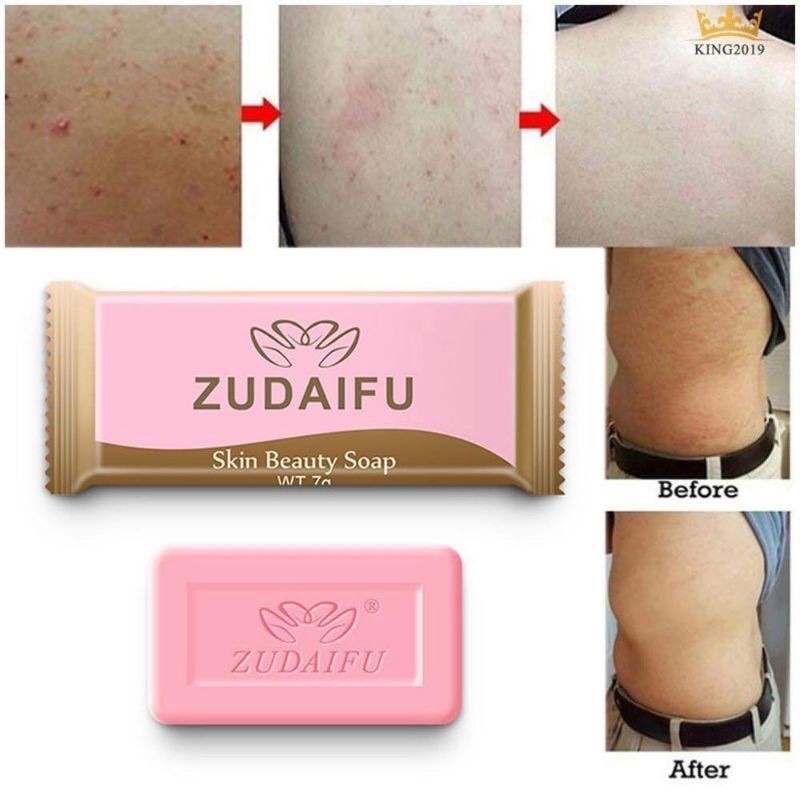 Sabun Gatal Jerawat Badan Panau Kurap Gatal Enzema Soap Elergic Itch Body Acne Shopee Malaysia