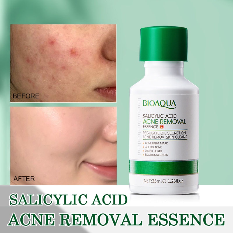 Salicylic Acid Pimple Remover Serum for Acne and Pimple Mark Anti Acne Removal Serum Anti Aging