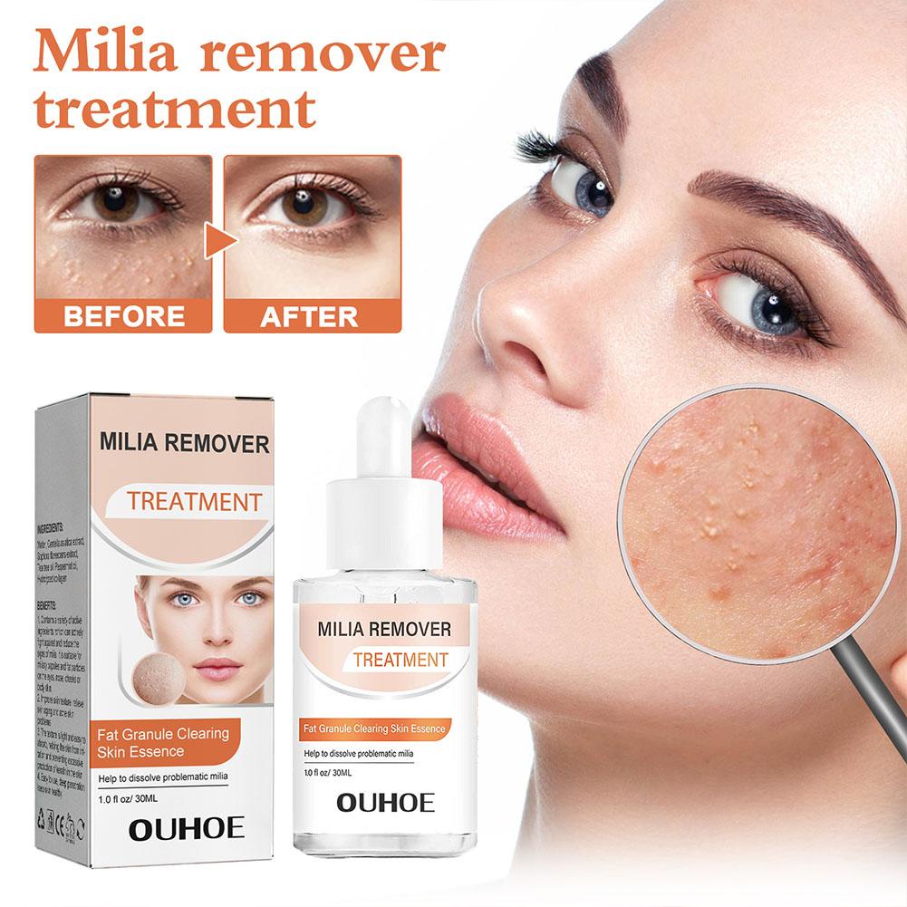 30ml Milia Remover Essence Fat Granule Skin Clearing Serum Under Eye ...