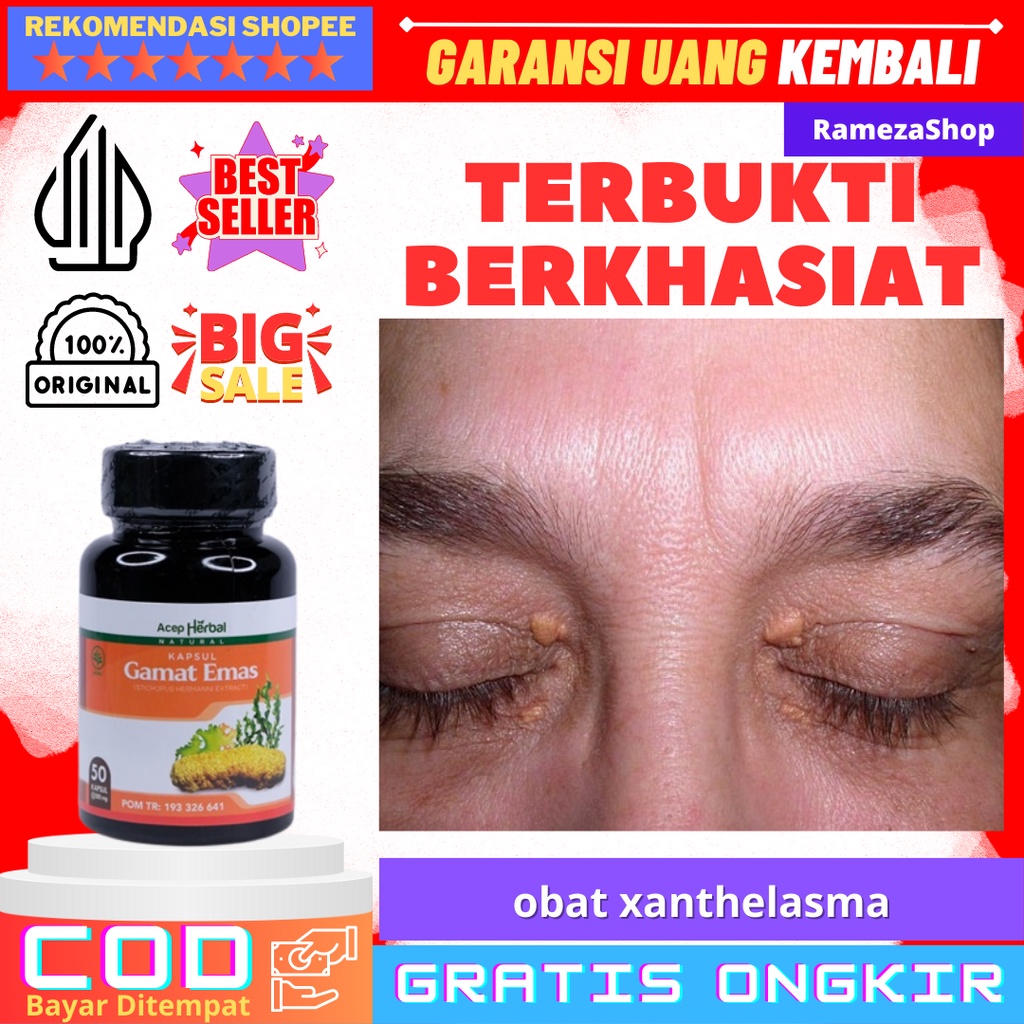 MATA Xanthelasma Medicines For Removing Xanthelasma, Xanthelasma Removal Drugs, Eye Fat Plaque