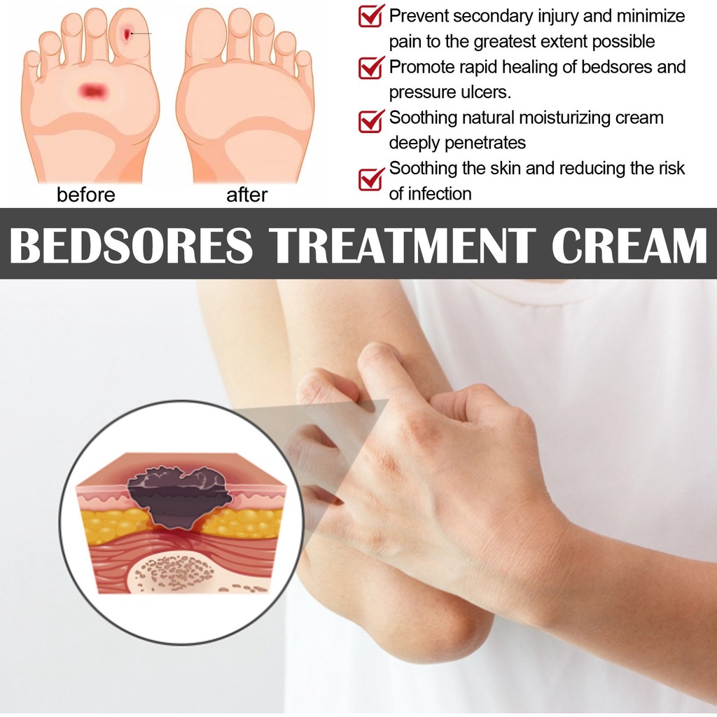 Bedsores Wound Healing Cream Inhibit Fungal Pressure Sores Treatment
