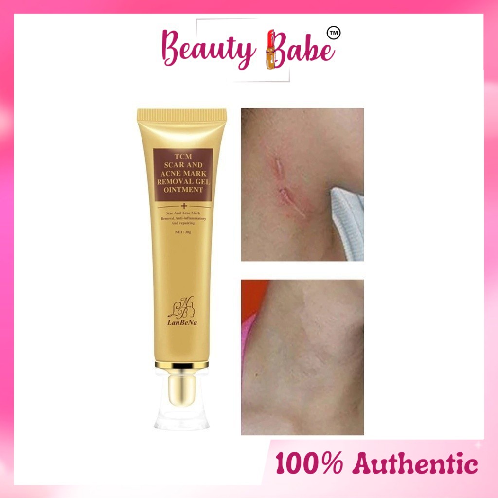 LANBENA Scar Removal Cream Acne Treatment Cream 30g [Beauty Babe