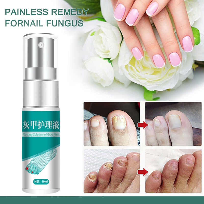 Nail Fungus Treatments Serum Spray Repair Toe Nail Fungal Removal