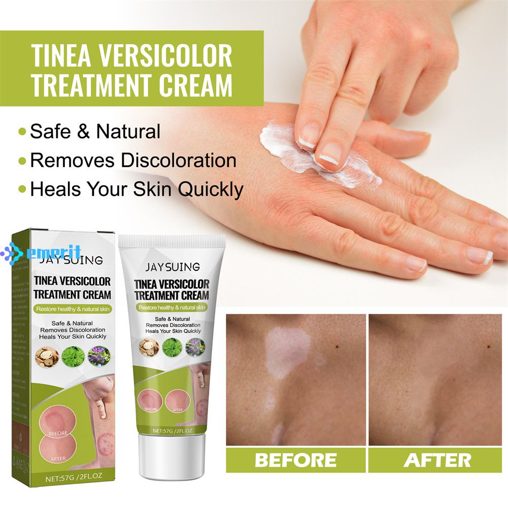 Jaysuing Tinea Versicolor Repair Cream Reduce Redness Swelling Remove