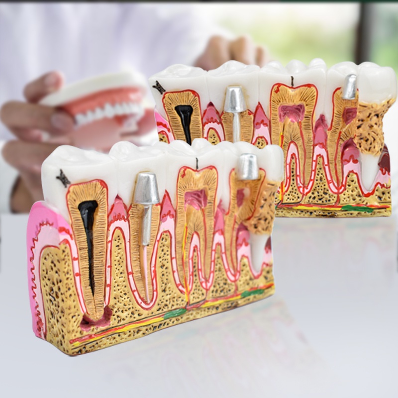 Tooth Model Dental Caries Anatomy Comprehensive Pathology Tooth Nerve